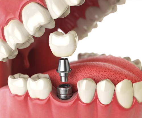 Treatment - beechcroft