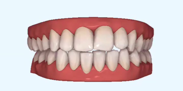 Platinum Invisalign Images
