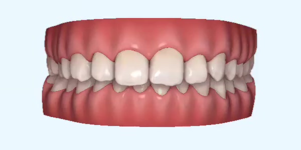 Platinum Invisalign Images