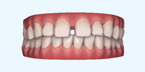 Platinum Invisalign Images
