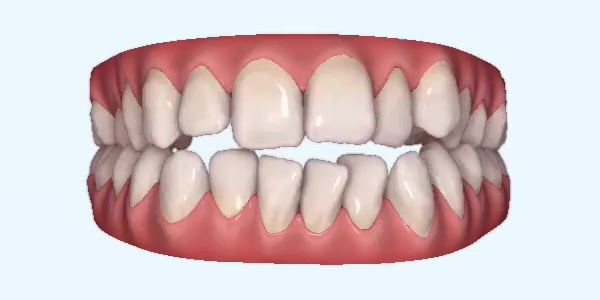 Platinum Invisalign Images