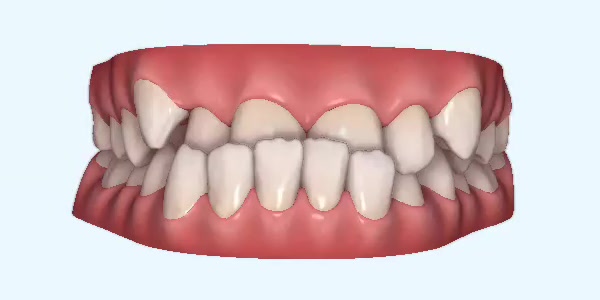 Platinum Invisalign Images