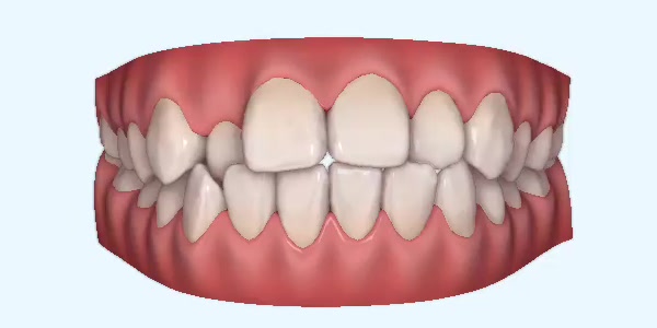Platinum Invisalign Images