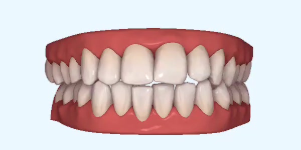 Platinum Invisalign Images