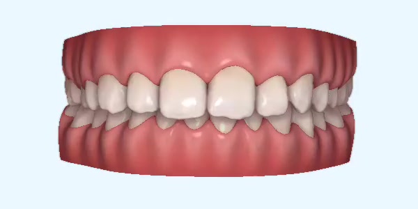 Platinum Invisalign Images