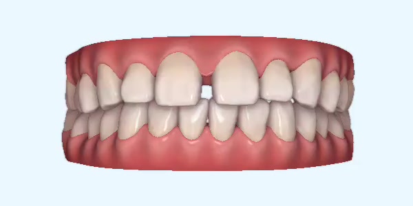 Platinum Invisalign Images