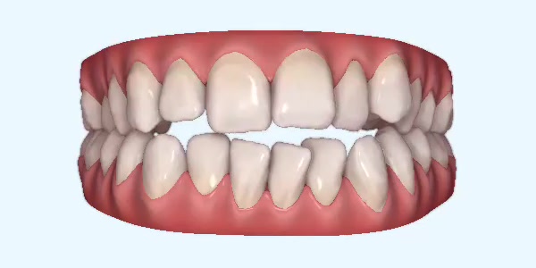 Platinum Invisalign Images