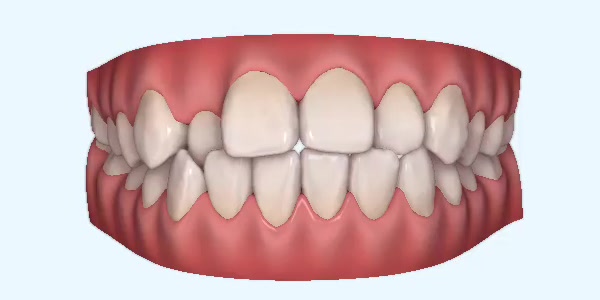 Platinum Invisalign Images