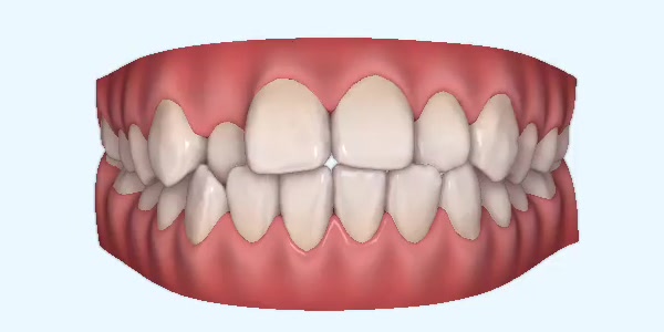 Platinum Invisalign Images