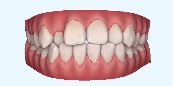 Platinum Invisalign Images