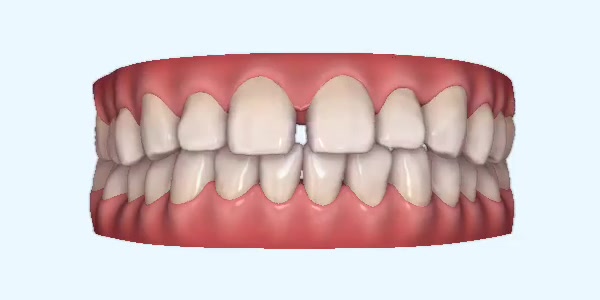 Platinum Invisalign Images