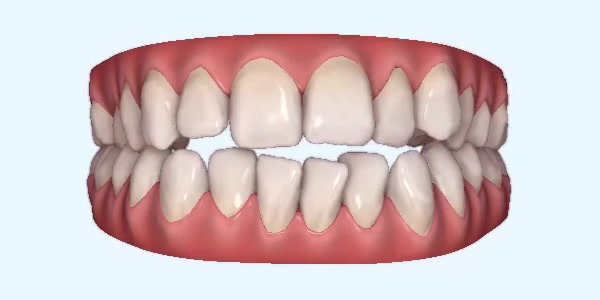 Platinum Invisalign Images