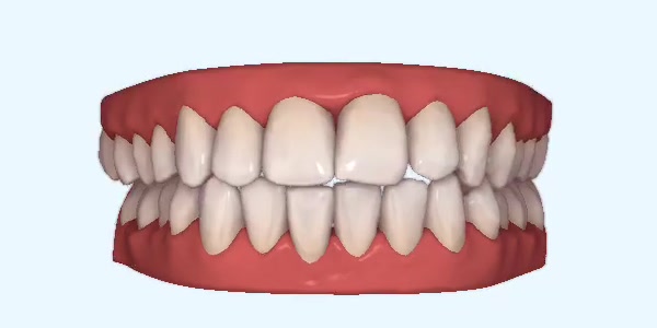 Platinum Invisalign Images