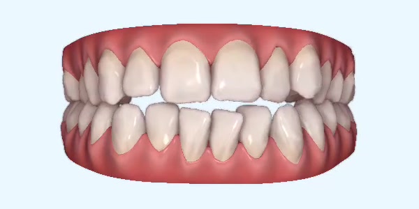 Platinum Invisalign Images