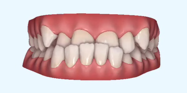Platinum Invisalign Images