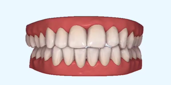 Platinum Invisalign Images