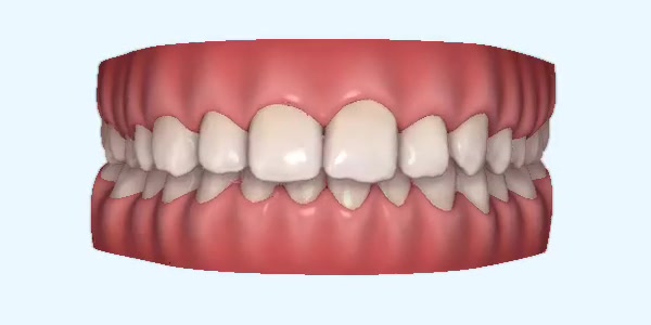 Platinum Invisalign Images