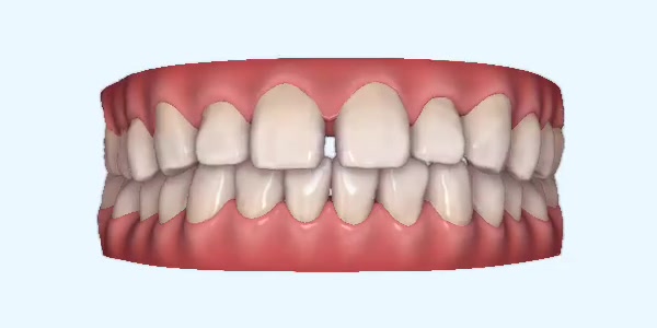 Platinum Invisalign Images