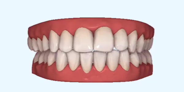 Platinum Invisalign Images