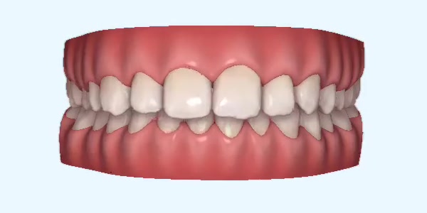 Platinum Invisalign Images