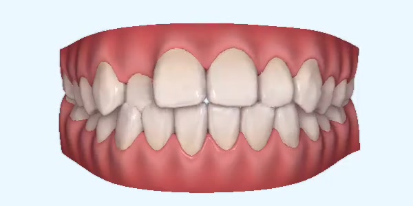 Platinum Invisalign Images