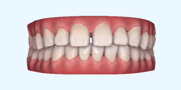 Platinum Invisalign Images