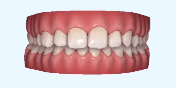 Platinum Invisalign Images