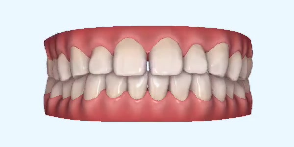 Platinum Invisalign Images