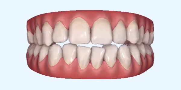 Platinum Invisalign Images