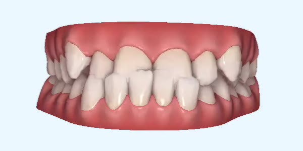 Platinum Invisalign Images