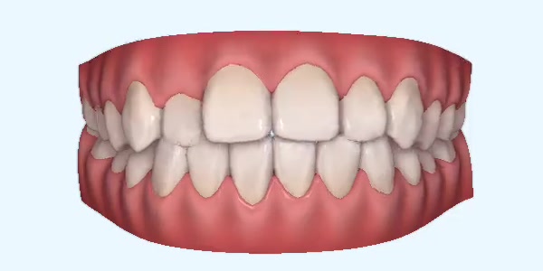 Platinum Invisalign Images