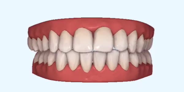 Platinum Invisalign Images