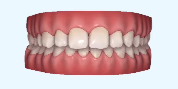 Platinum Invisalign Images