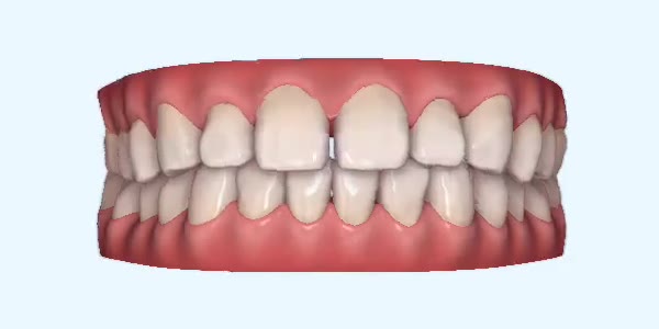 Platinum Invisalign Images