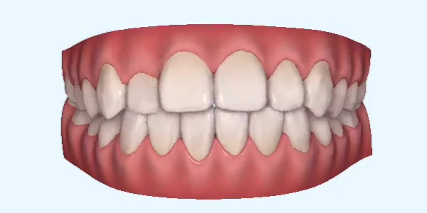 Platinum Invisalign Images