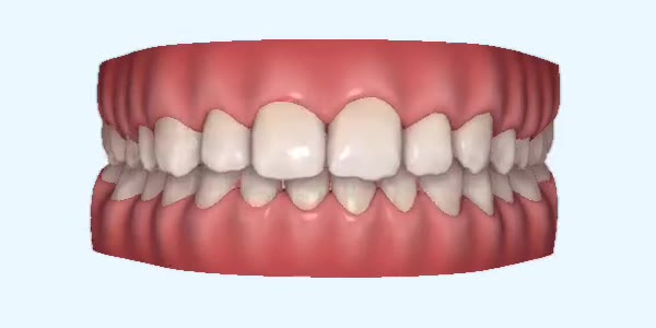 Platinum Invisalign Images