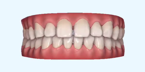 Platinum Invisalign Images