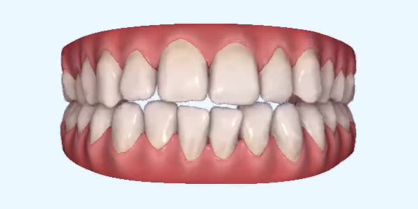 Platinum Invisalign Images