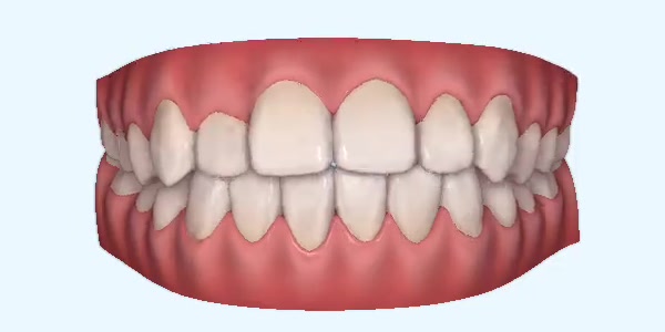 Platinum Invisalign Images