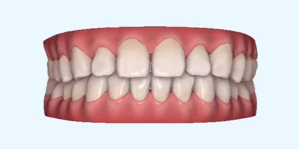 Platinum Invisalign Images