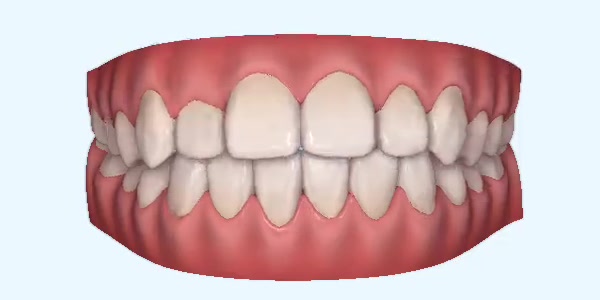 Platinum Invisalign Images