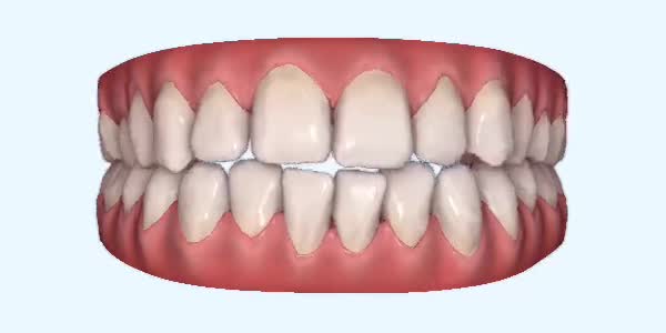 Platinum Invisalign Images
