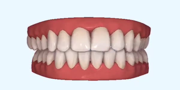 Platinum Invisalign Images