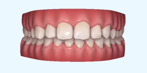 Platinum Invisalign Images