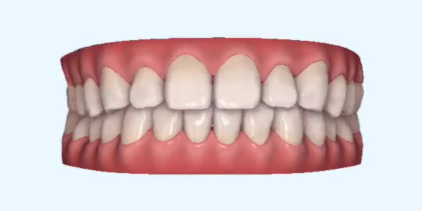 Platinum Invisalign Images