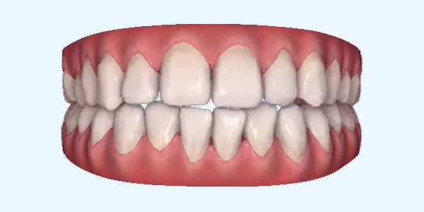 Platinum Invisalign Images