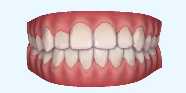 Platinum Invisalign Images