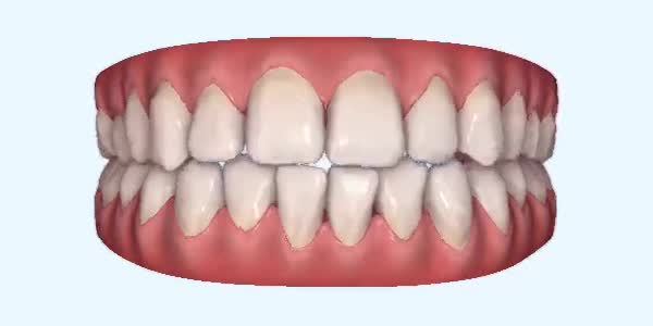 Platinum Invisalign Images