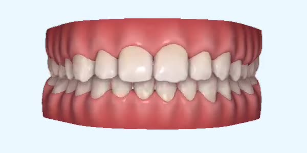 Platinum Invisalign Images