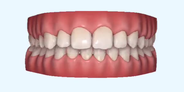 Platinum Invisalign Images